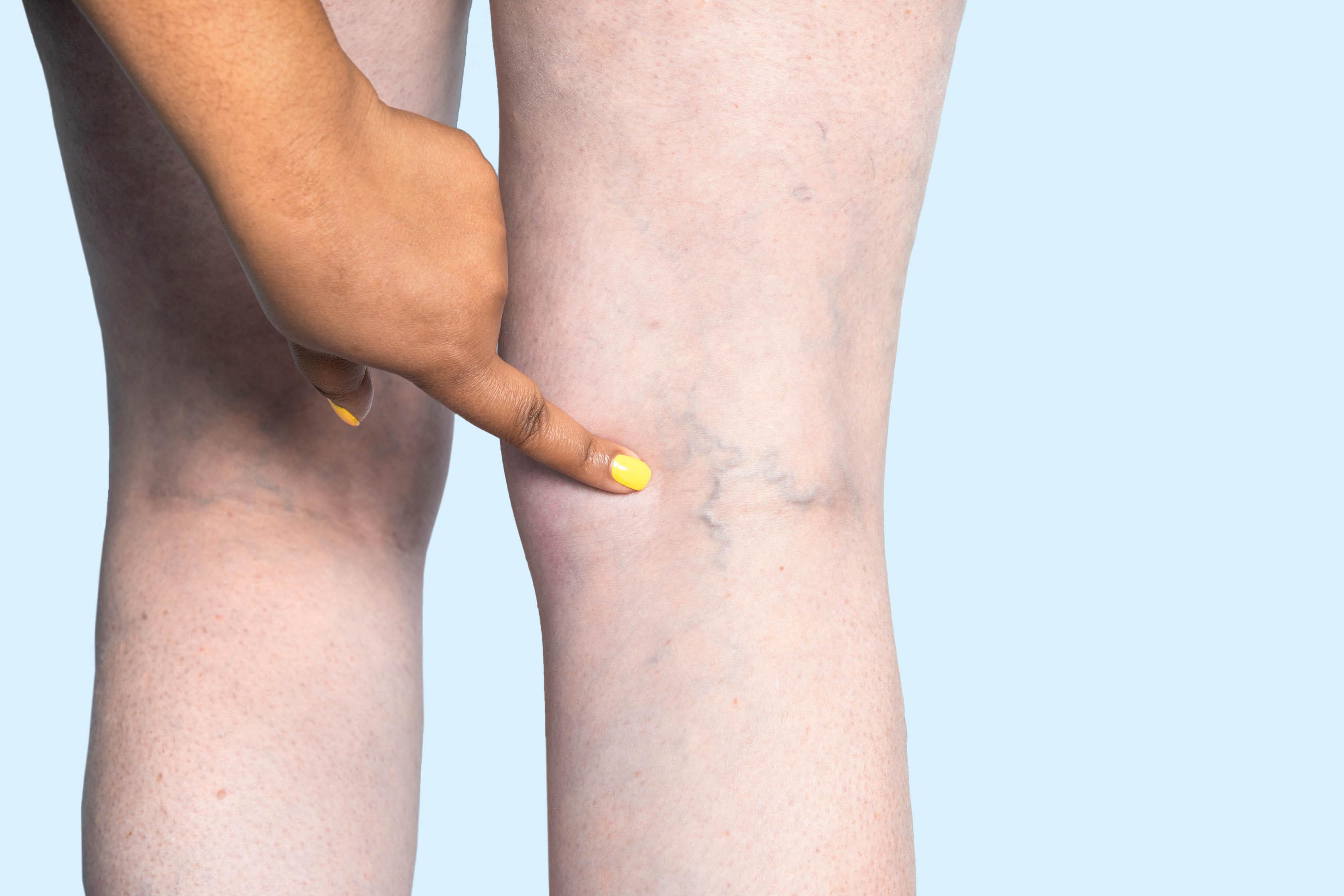 Understanding Chronic Venous⁣ Insufficiency and Its Impact on Health
