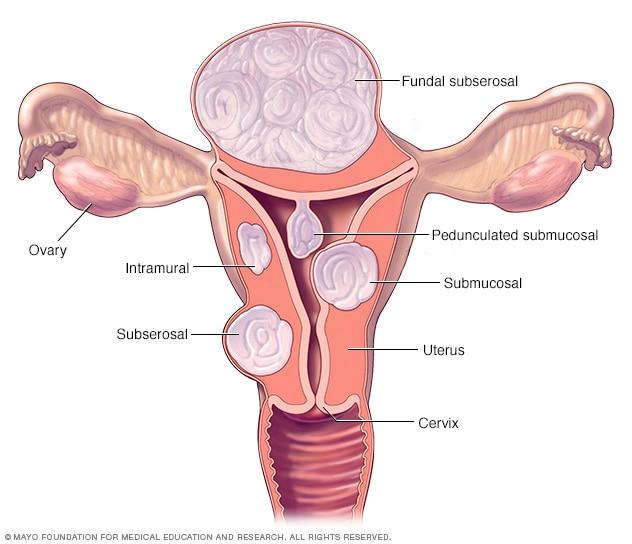 Understanding uterine Fibroids⁢ and Their Impact‌ on Women's health