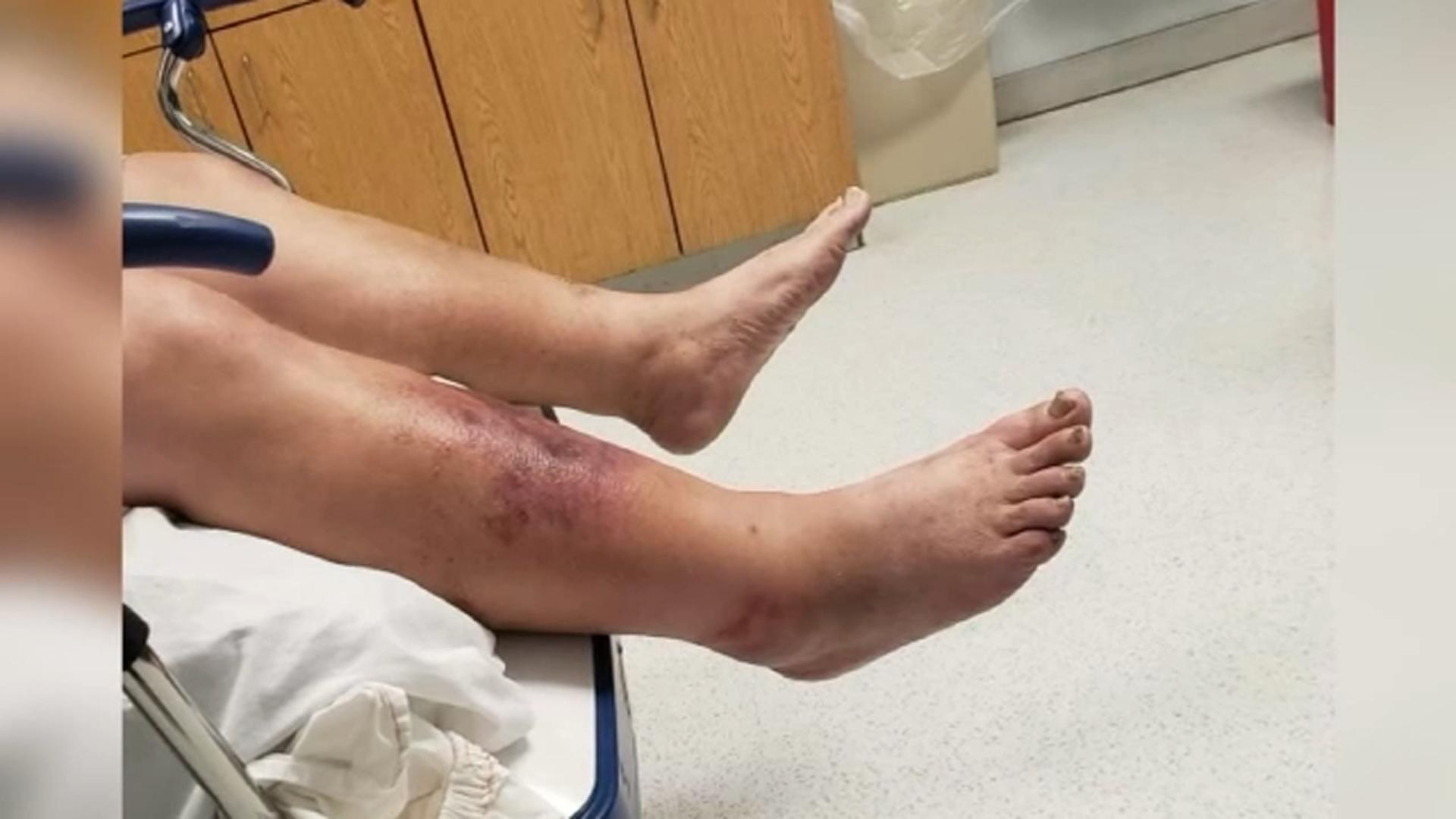 Understanding the Deadly Nature of Flesh-Eating Bacteria ⁤and Their Impact in Florida