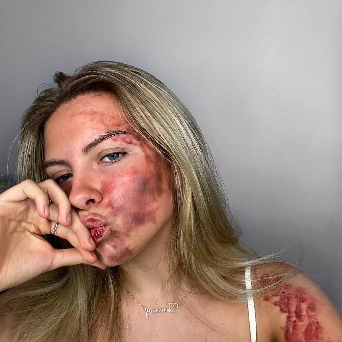 Expert Perspectives on ⁢Diagnosing and‌ Managing Facial Bruising